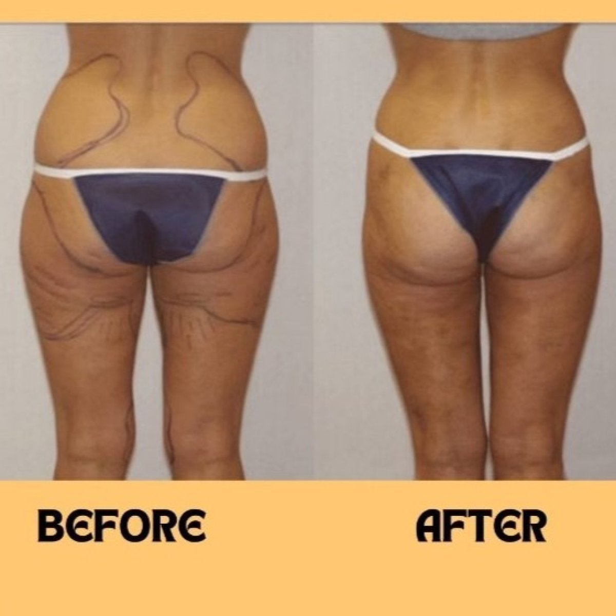 360 liposuction before and after results at ID Clinic Bangkok, improved body contour visible