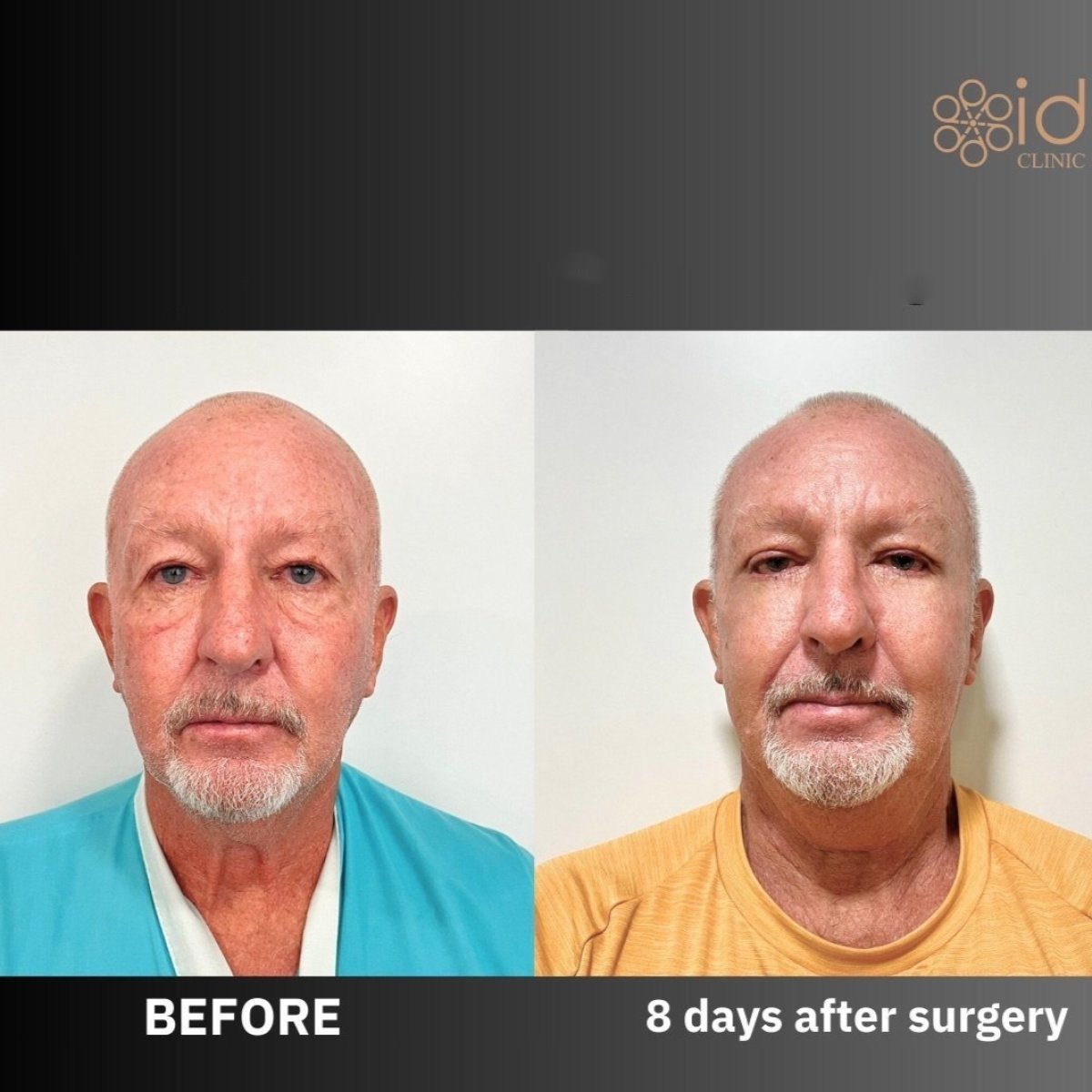 Результаты блефаропластики век до и после в ID Clinic Bangkok, 8 дней после операции