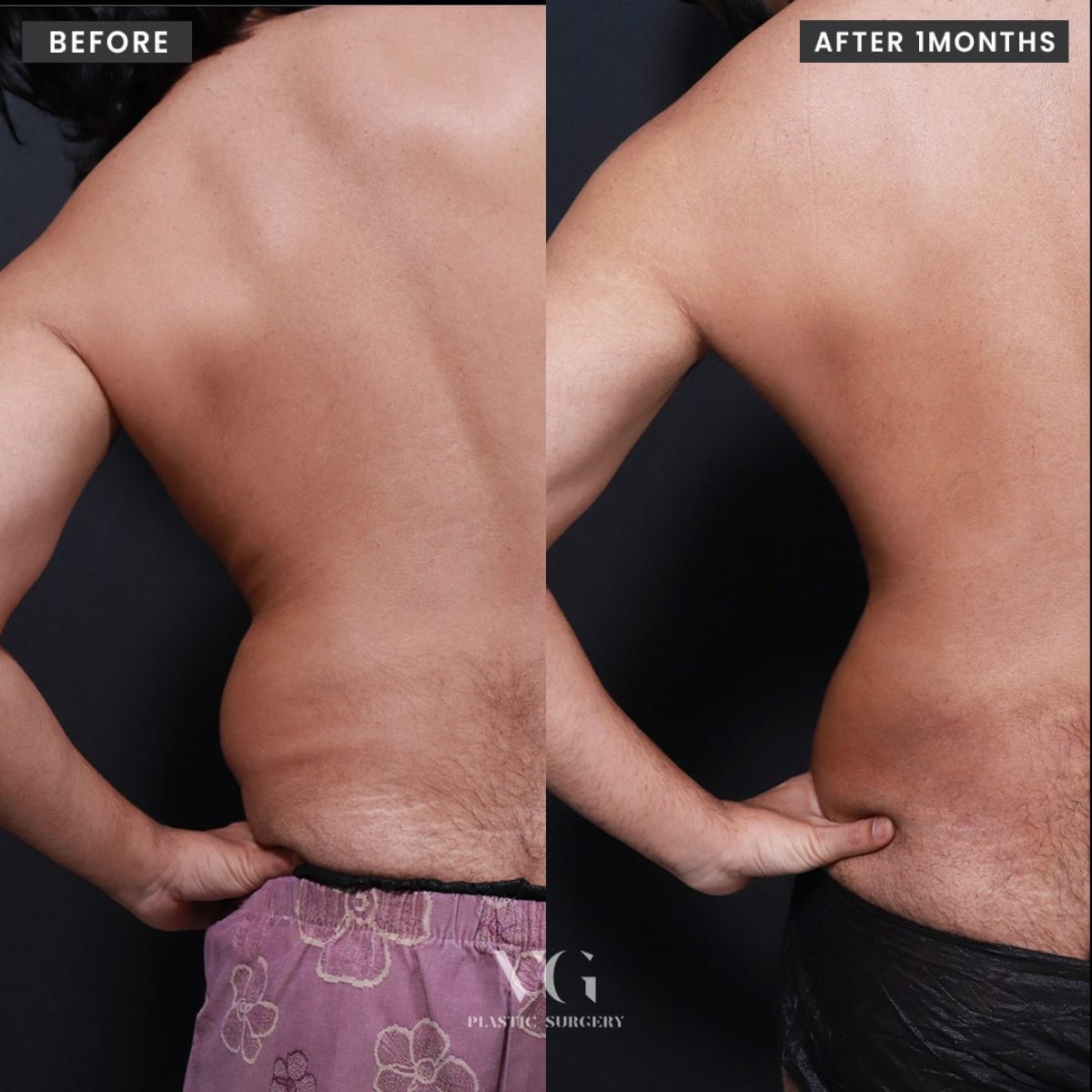 Результаты липосакции до и после в VG Plastic Surgery, видимое улучшение контура спины