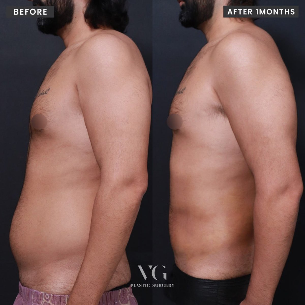 Resultados de liposucción antes y después en VG Plastic Surgery, mejora del contorno abdominal