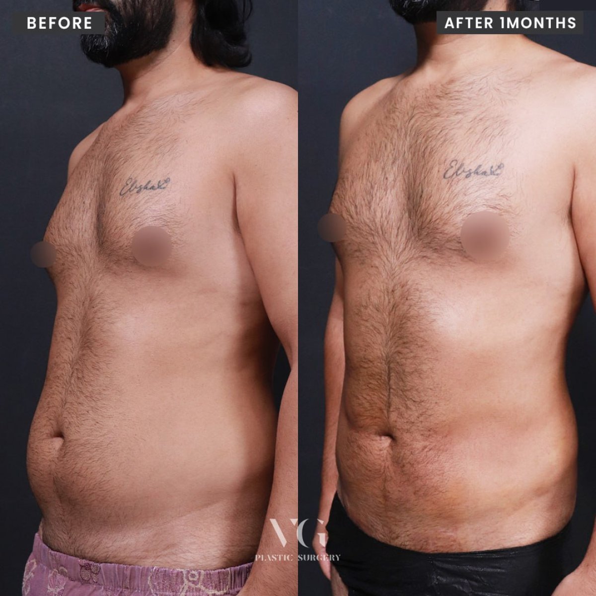Resultados de liposucción antes y después en VG Plastic Surgery, mejora visible del abdomen