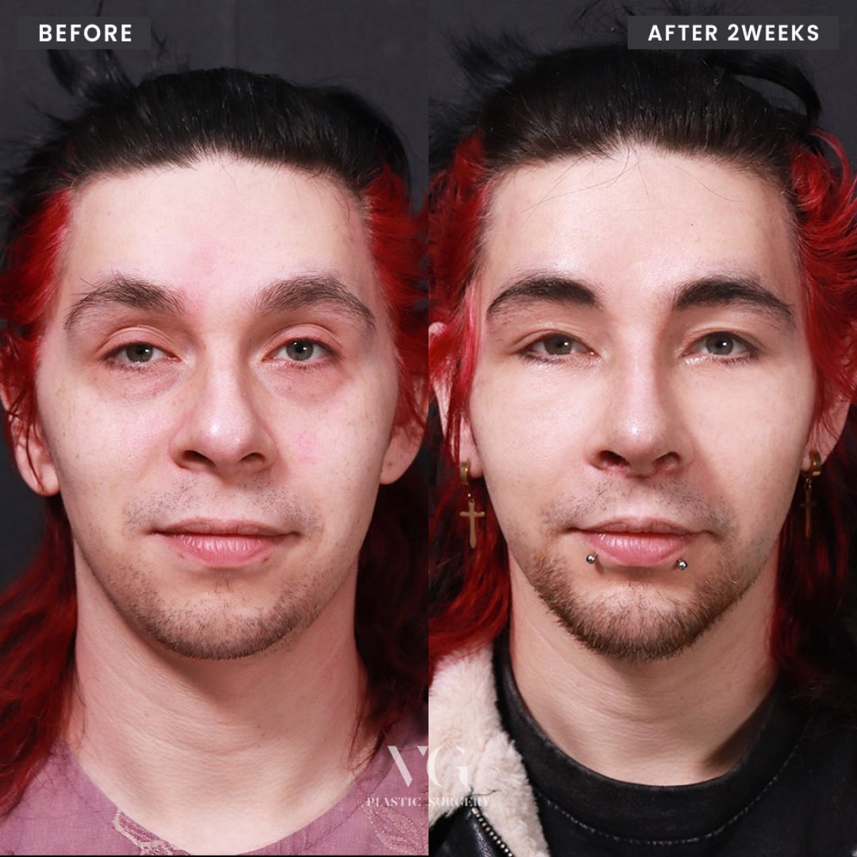 Male rhinoplasty before and after results at VG Plastic Surgery, improved nose shape in 2 weeks
