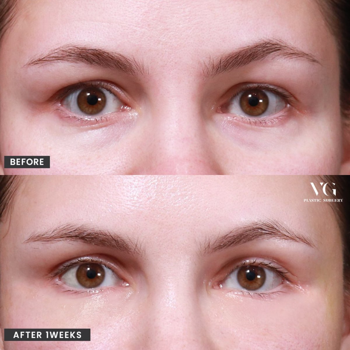 نتائج قبل وبعد جراحة الجفون العلوية والسفلية في عيادة VG Plastic Surgery