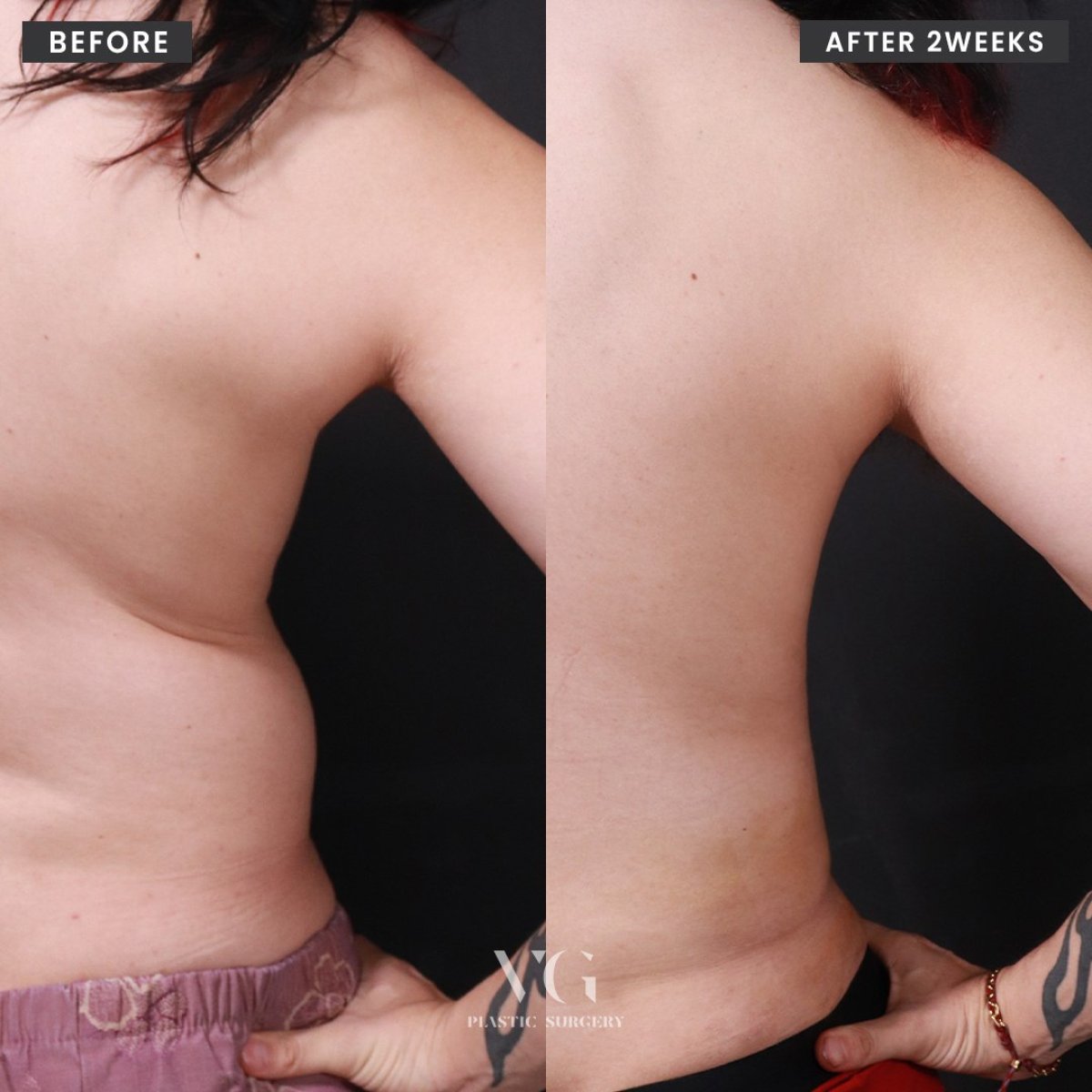 Результати ліпосакції до і після у VG Plastic Surgery, помітне покращення контуру талії