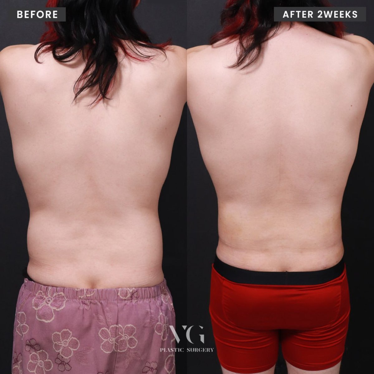 Resultados de liposucción antes y después en VG Plastic Surgery, mejora visible del contorno de la espalda