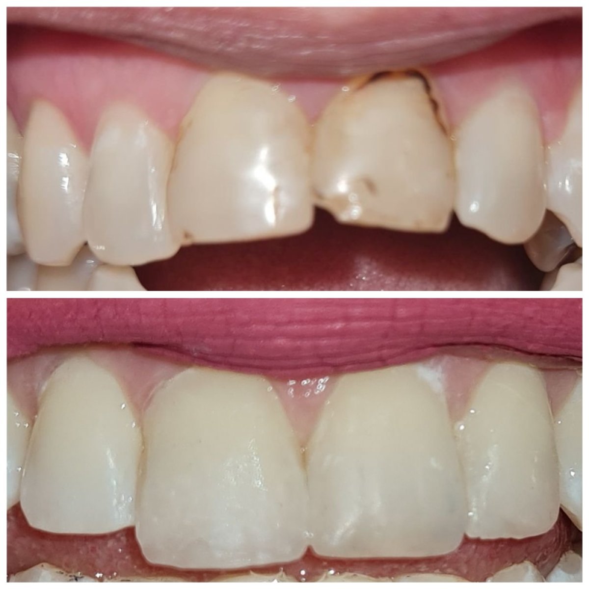Resultados antes y después de bonding dental en SoftDentalCare Clinic para dientes frontales
