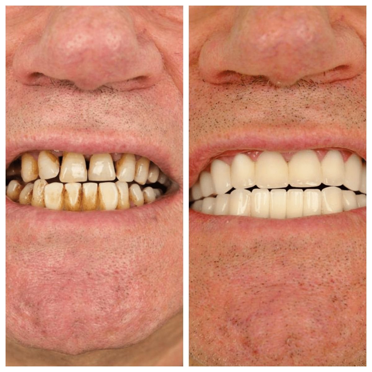نتائج زراعة الأسنان قبل وبعد في YEG Clinic – ابتسامة مستعادة وأسنان أكثر بياضًا
