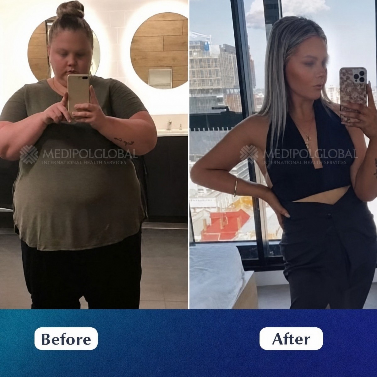Before and after gastric sleeve surgery results at Medipol Acibadem District Hospital