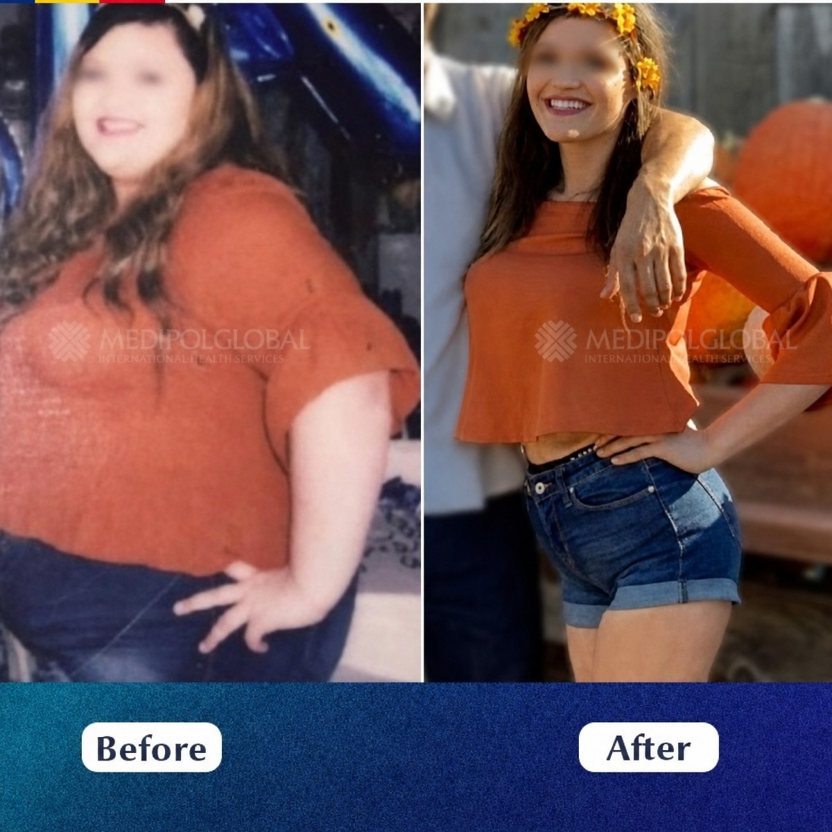 Before and after gastric sleeve surgery results at Medipol Acibadem District Hospital
