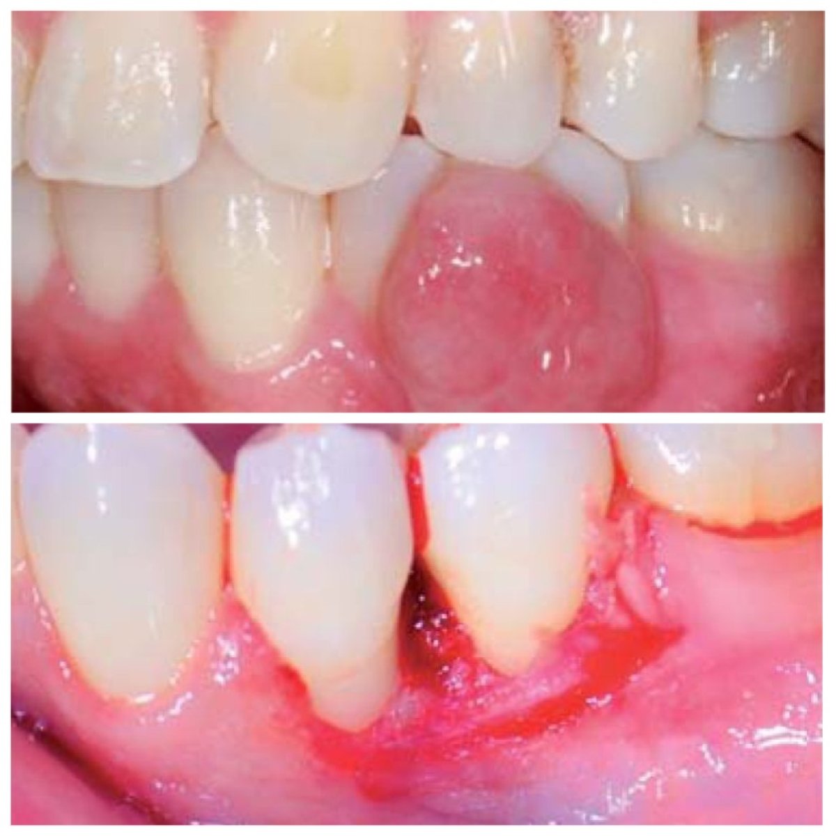 Resultados antes y después de gingivectomía en SoftDentalCare Clinic – contorno mejorado