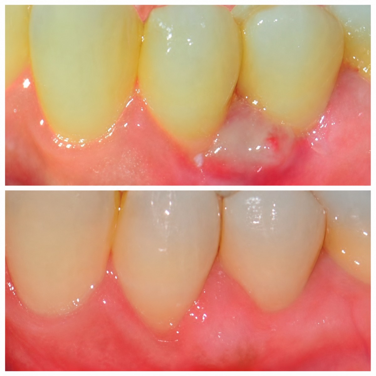 Resultados antes y después de gingivectomía en SoftDentalCare Clinic – contorno mejorado
