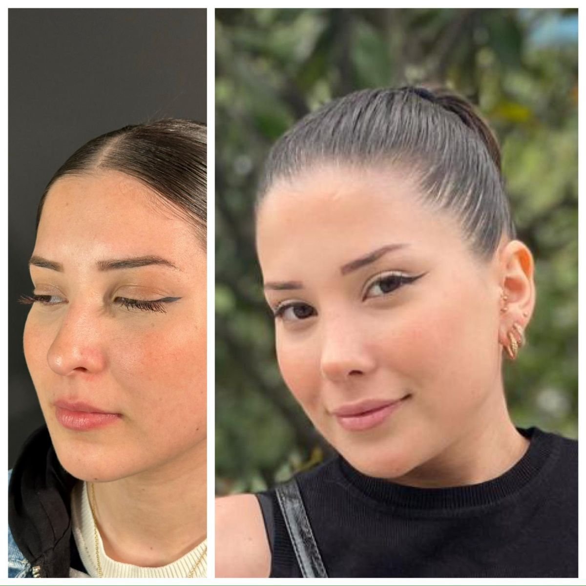 Resultados de rinoplastia antes y después en Quartz Hospital, remodelación nasal natural