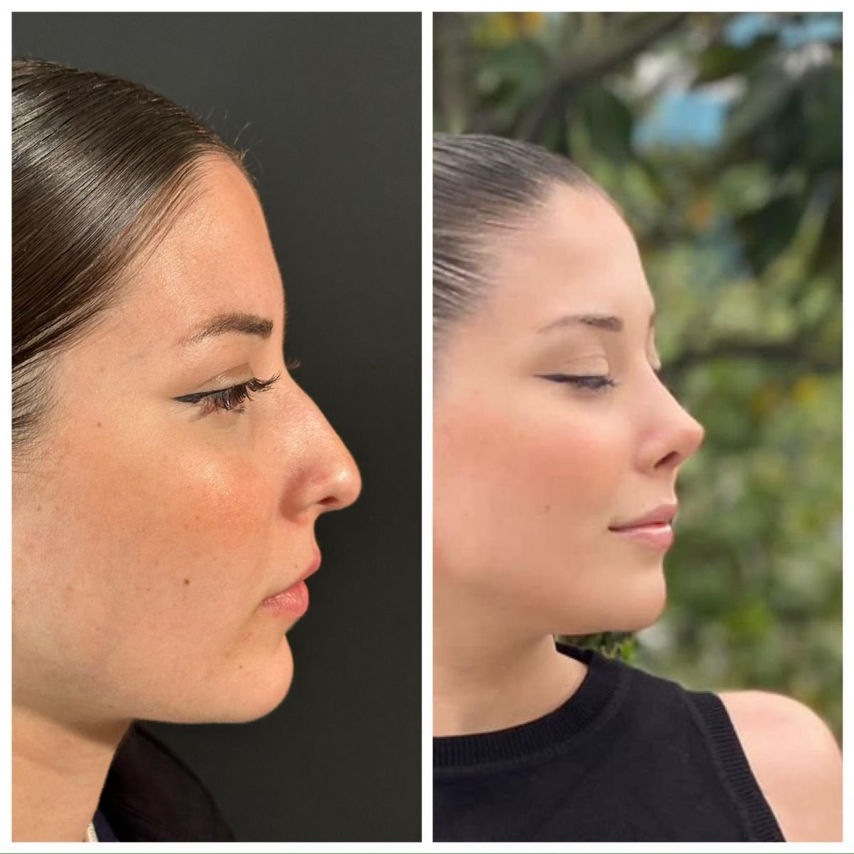 Before and after rhinoplasty results at Quartz Hospital, nose reshaping with natural look