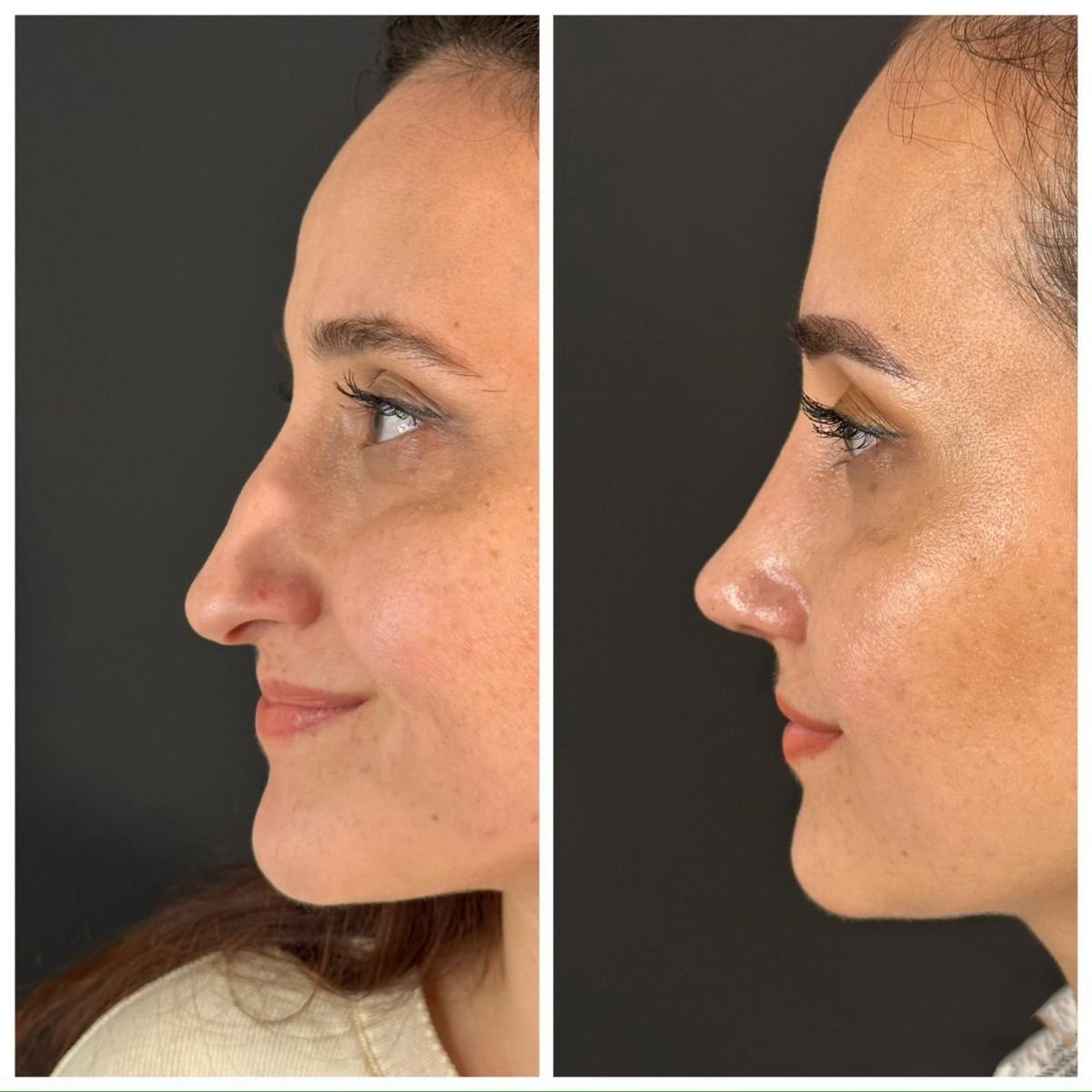Before and after rhinoplasty results at Quartz Hospital, nose reshaping with natural look
