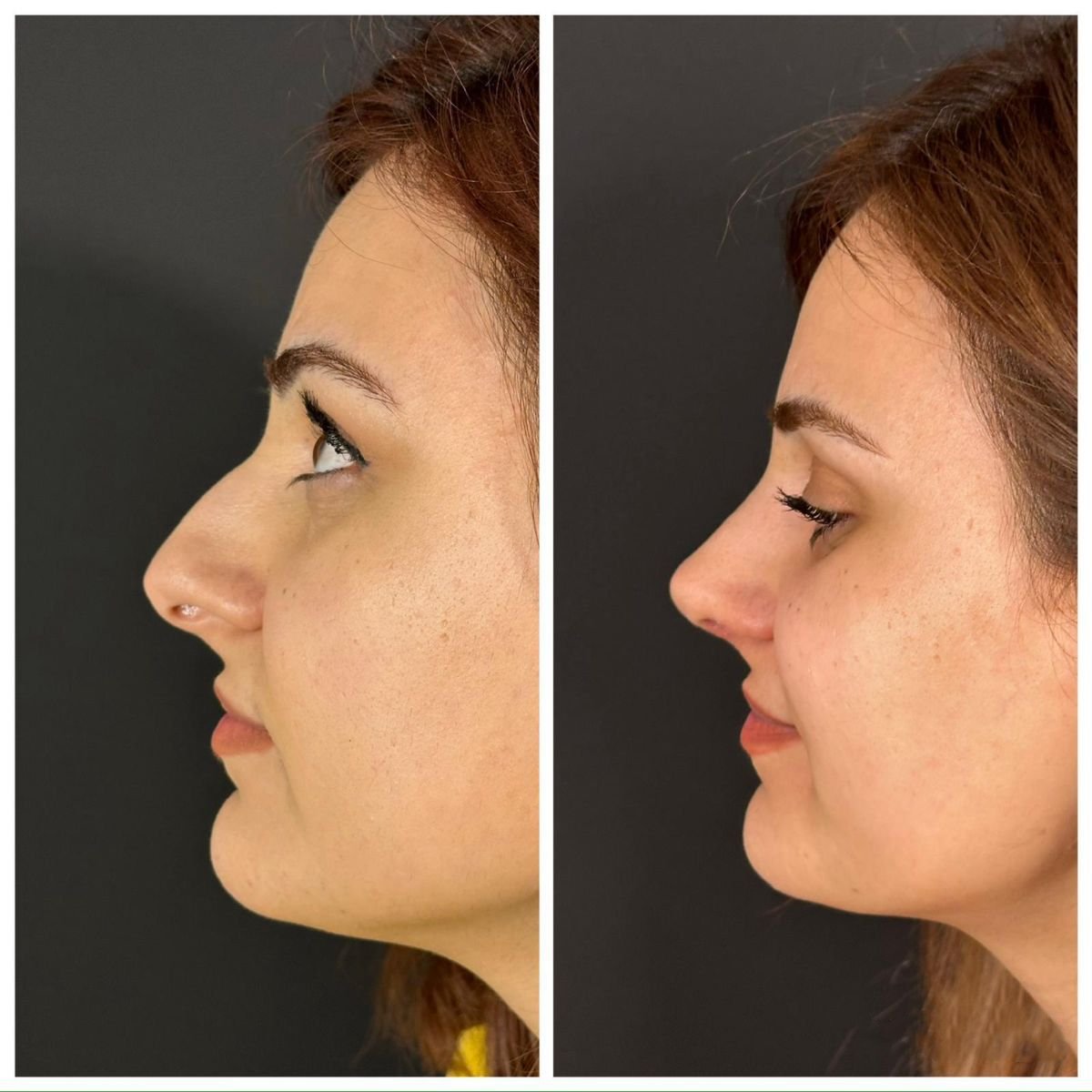 Before and after rhinoplasty results at Quartz Hospital, nose reshaping with natural look