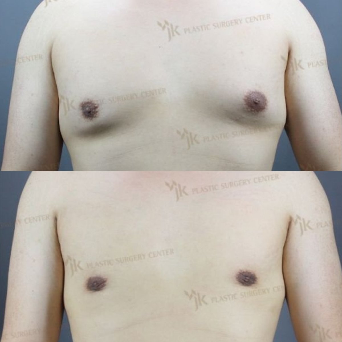 Результаты до и после операции гинекомастии в JK Plastic Surgery Center, коррекция груди
