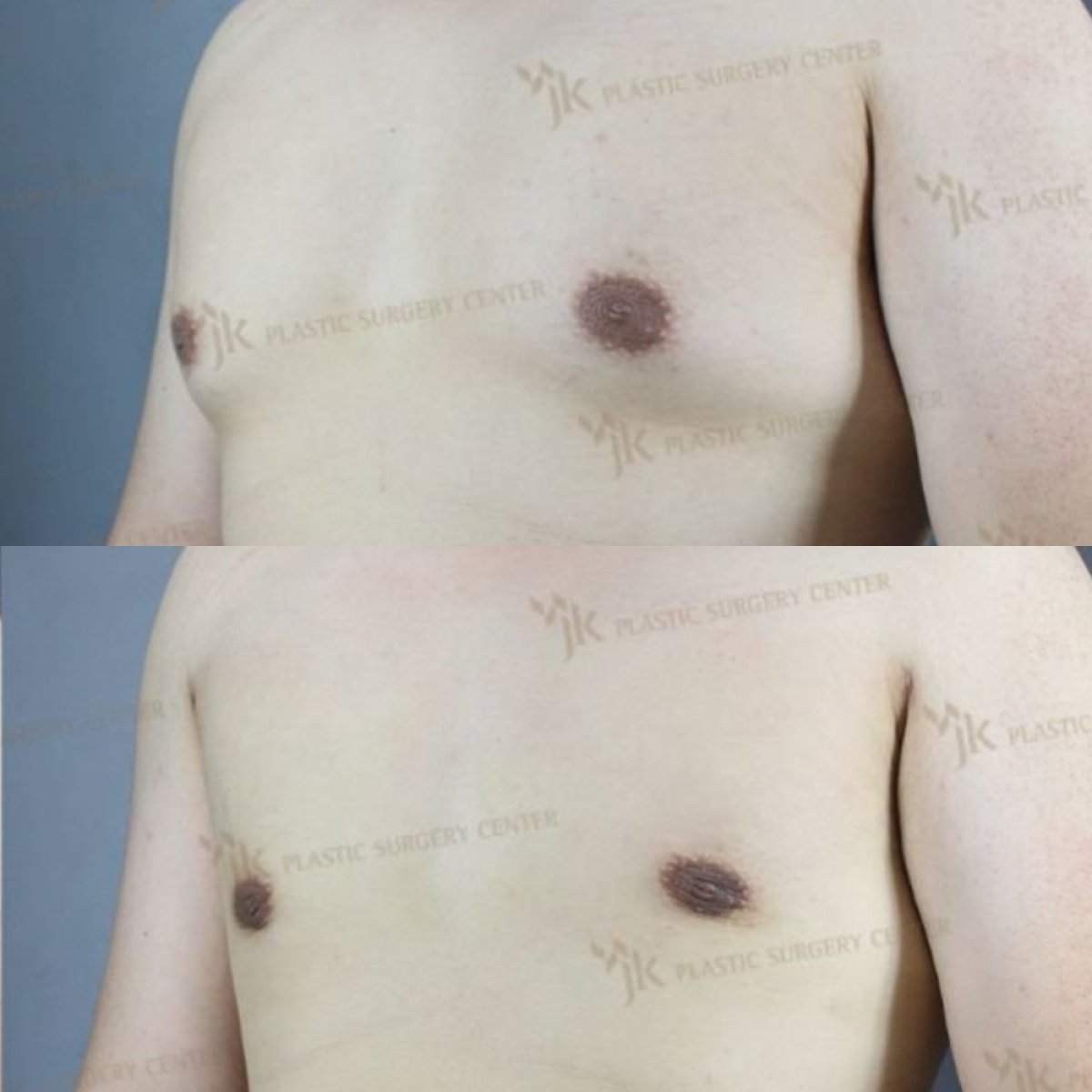 Результаты до и после операции гинекомастии в JK Plastic Surgery Center, плоская грудь