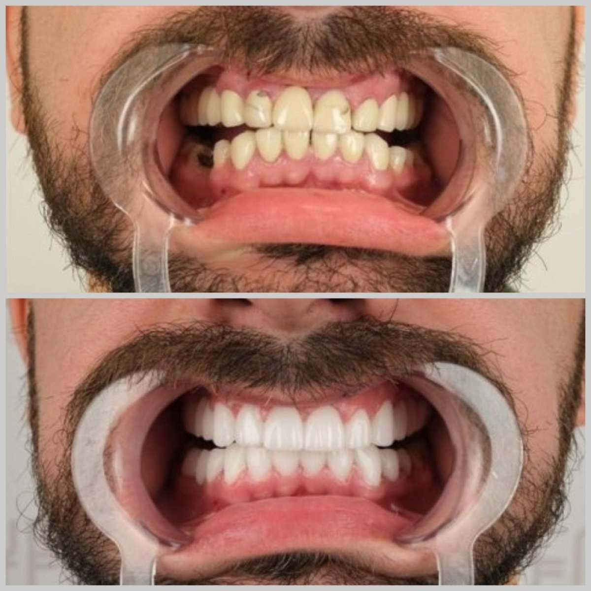 Resultados de implantes dentales de carga inmediata en YEG Clinic, sonrisa mejorada
