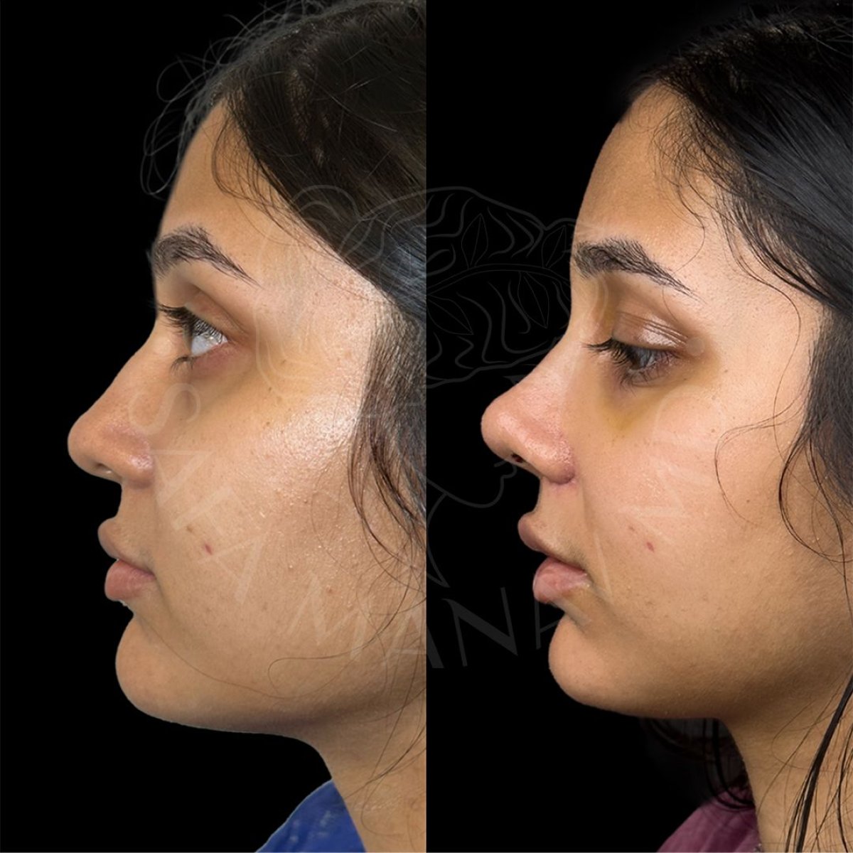 Resultados de rinoplastia antes y después en Dr. Safa Manav Clinic, mejora de la nariz