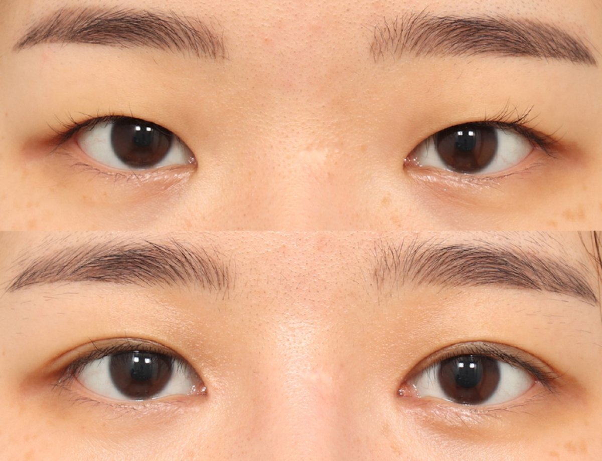 Efekty blefaroplastyki przed i po w AB PLASTIC SURGERY, korekta powiek