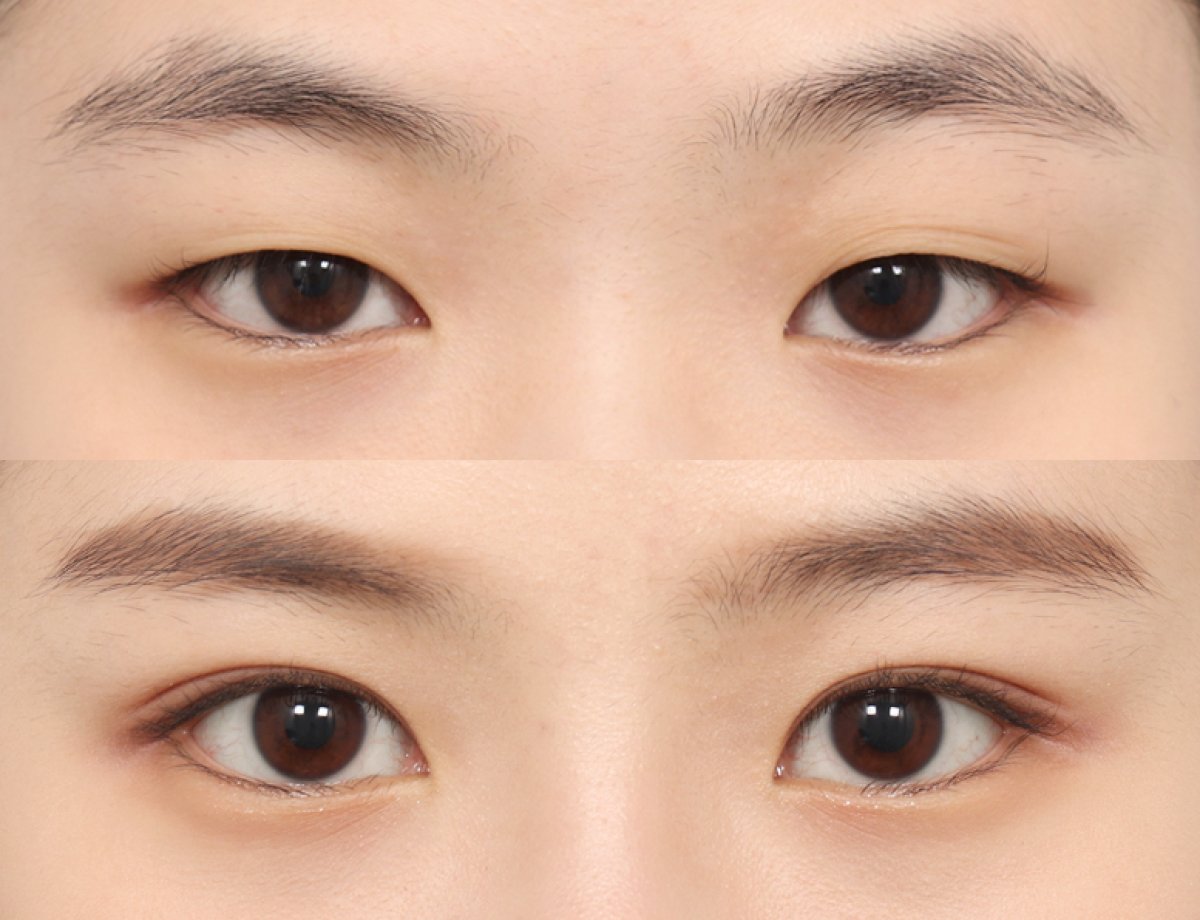 Before and after blepharoplasty at AB PLASTIC SURGERY, eyelid correction with natural result