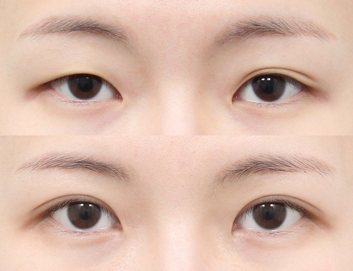 Resultados de blefaroplastia antes y después en AB PLASTIC SURGERY, corrección de párpados