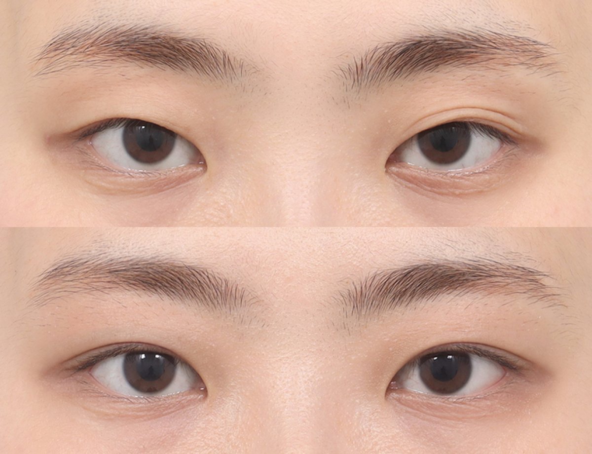 Before and after blepharoplasty results at AB PLASTIC SURGERY, eyelid correction improvement
