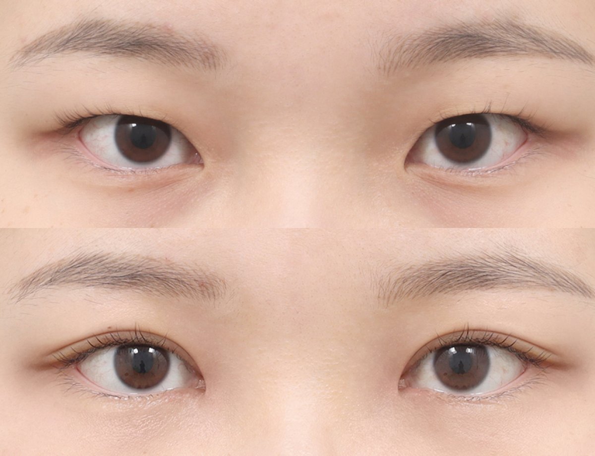 Before and after blepharoplasty results at AB PLASTIC SURGERY, eyelid correction improvement