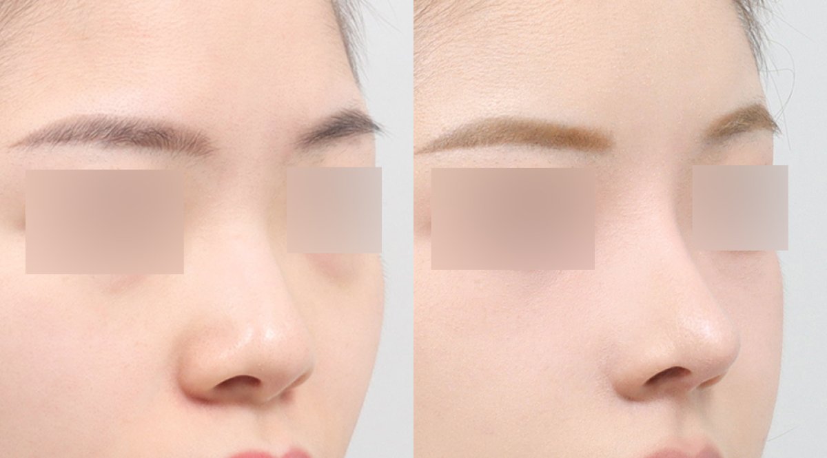 نتائج تجميل الأنف قبل وبعد في AB PLASTIC SURGERY، إعادة تشكيل الأنف بمظهر طبيعي