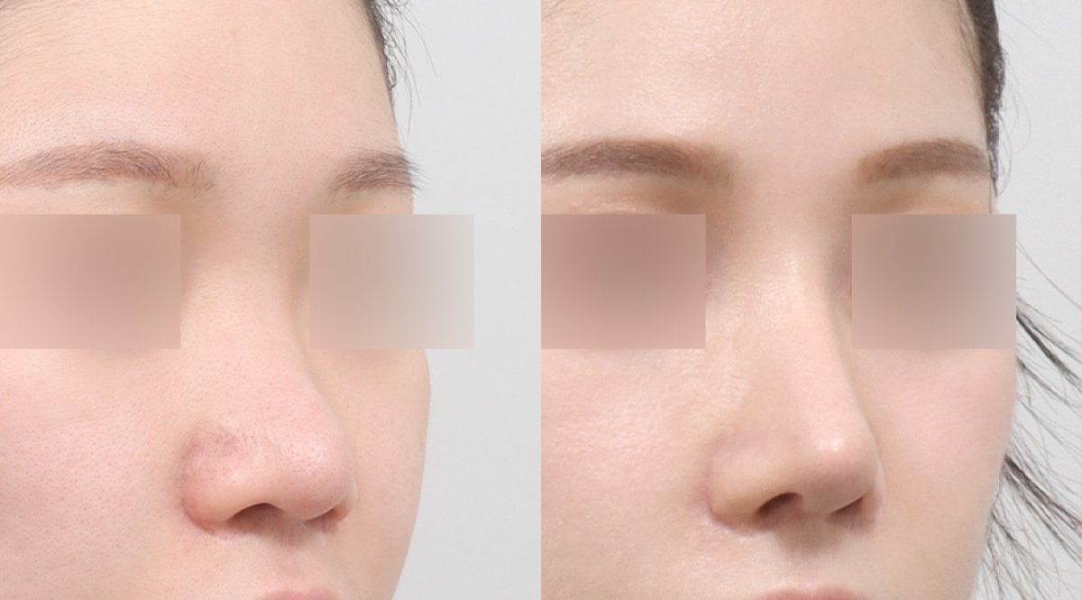 Resultados de rinoplastia antes y después en AB PLASTIC SURGERY, nariz de aspecto natural