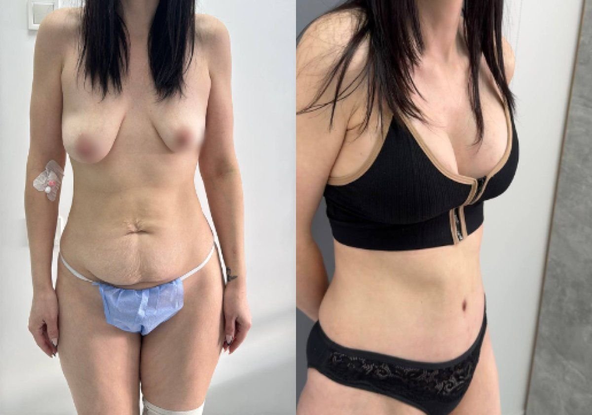 Résultats avant et après liposuccion à la Dmytrii Homola Clinic, silhouette améliorée visible