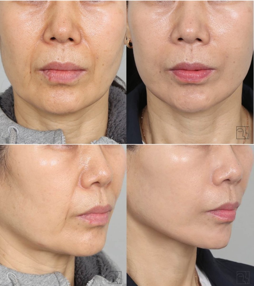 Facelift before and after results – visible facial rejuvenation and smoother skin appearance