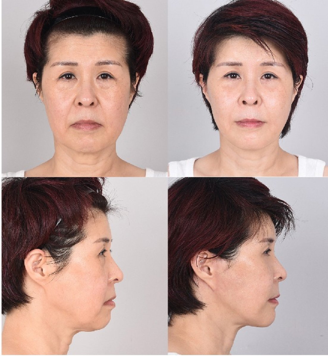 Facelift before and after results – visible facial rejuvenation and tighter jawline