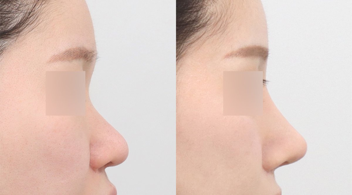 Resultados de rinoplastia antes y después en AB PLASTIC SURGERY, remodelación nasal natural