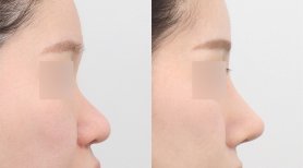 Ergebnisse der Rhinoplastik (Nasenkorrektur) durch Dr. Jooyoun Kim — Vorher- und Nachher-Fotos des Patienten Fotos vor und nach Rhinoplastik (Nasenkorrektur) durch Dr. Jooyoun Kim