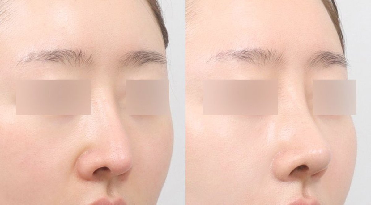 Before and after rhinoplasty results at AB PLASTIC SURGERY, nose reshaping for natural look