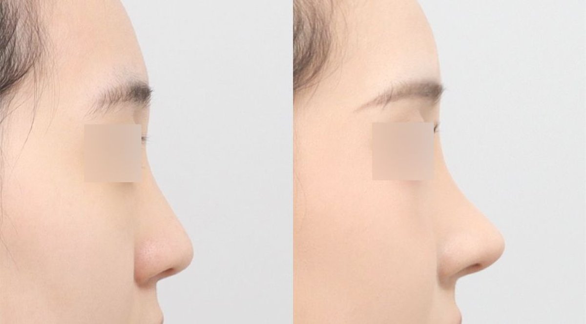 Результати ринопластики до і після в AB PLASTIC SURGERY, покращений профіль носа