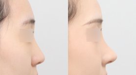 Ergebnisse der Rhinoplastik (Nasenkorrektur) durch Dr. Jooyoun Kim — Vorher- und Nachher-Fotos des Patienten Fotos vor und nach Rhinoplastik (Nasenkorrektur) durch Dr. Jooyoun Kim