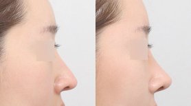 Ergebnisse der Rhinoplastik (Nasenkorrektur) durch Dr. Jooyoun Kim — Vorher- und Nachher-Fotos des Patienten Fotos vor und nach Rhinoplastik (Nasenkorrektur) durch Dr. Jooyoun Kim