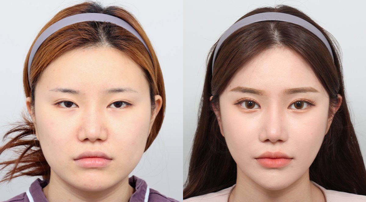 Результаты контурирования лица до и после в AB PLASTIC SURGERY, улучшена симметрия