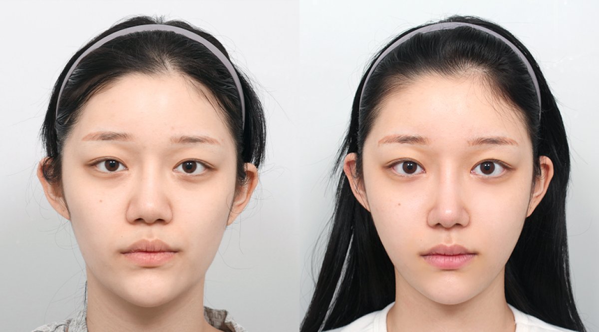 Результаты контурирования лица до и после в AB PLASTIC SURGERY, улучшена симметрия