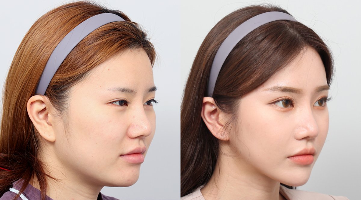 نتائج تحديد الوجه قبل وبعد في AB PLASTIC SURGERY – إبراز ملامح الوجه