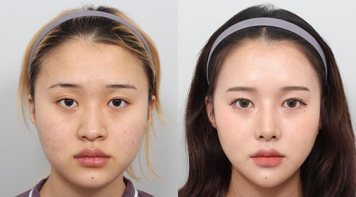 Результаты контурирования лица до и после в AB PLASTIC SURGERY, улучшена симметрия