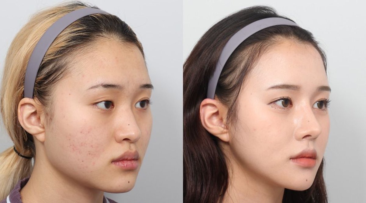Результаты контурирования лица до и после в AB PLASTIC SURGERY, улучшена симметрия