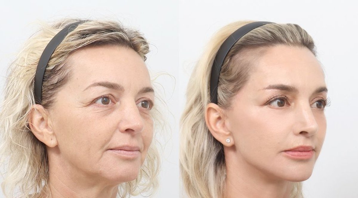 Facelift before and after results at AB PLASTIC SURGERY, visible facial rejuvenation effect