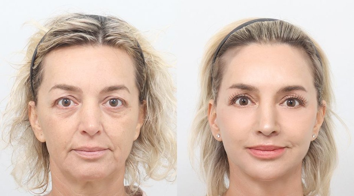 نتائج شد الوجه قبل وبعد في AB PLASTIC SURGERY، تجديد شباب البشرة ونعومتها