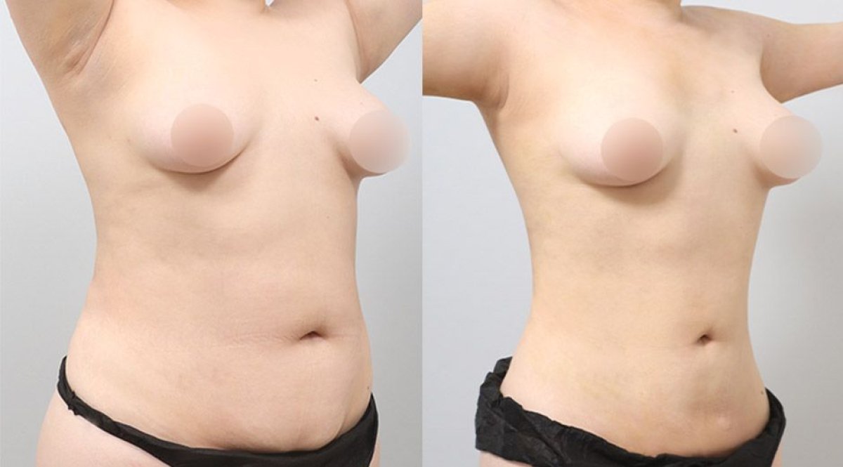 Before and after BodyTite body contouring results at AB PLASTIC SURGERY, abdomen and waist
