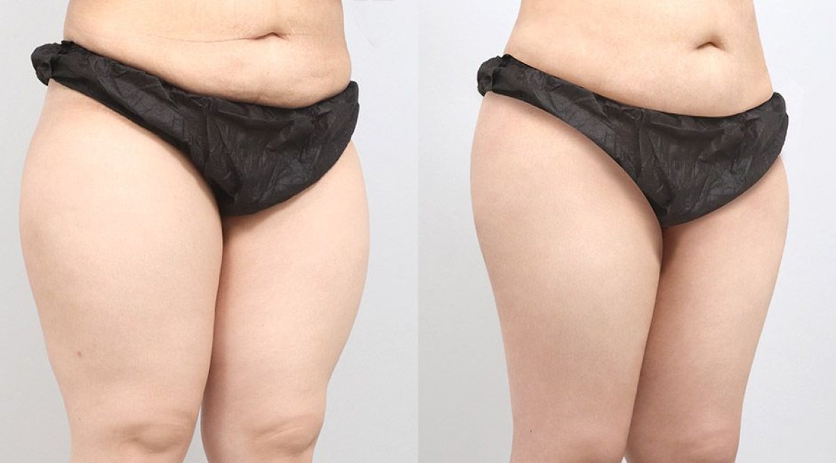 Résultats avant/après BodyTite remodelage corporel chez AB PLASTIC SURGERY, ventre et cuisses