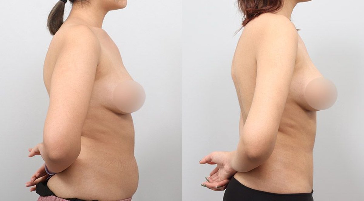 Resultados antes y después de BodyTite en AB PLASTIC SURGERY, abdomen más delgado