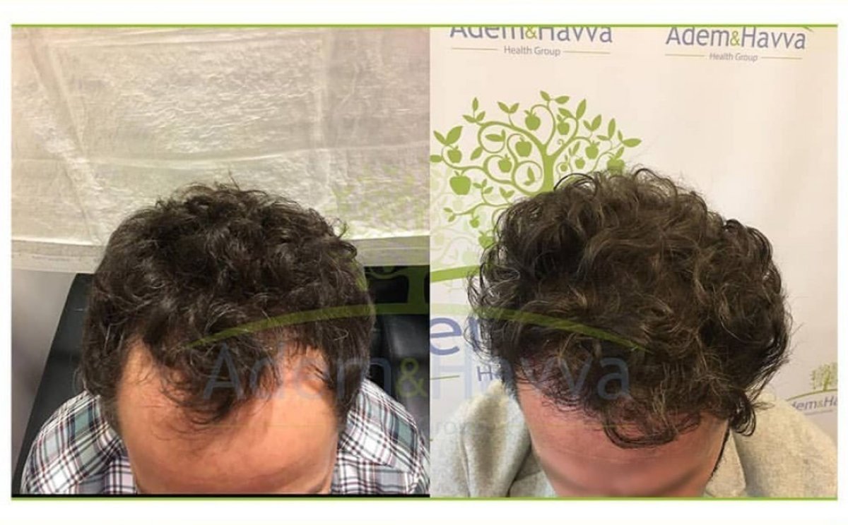 Resultados antes y después de trasplante capilar DHI en Adem and Havva Medical Center, línea mejorada